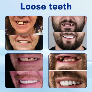 Nurbini™ Advanced Customized Full Denture