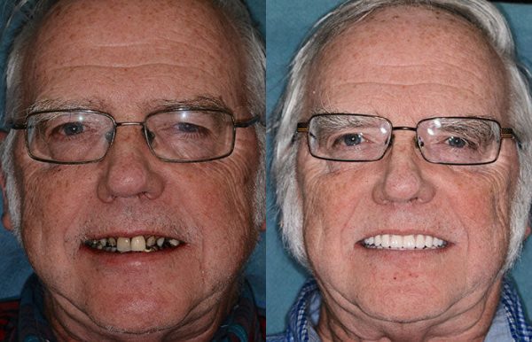 HZA™ Advanced Customized Full Denture Set - Image 8