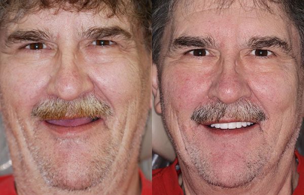 HZA™ Advanced Customized Full Denture Set - Image 10