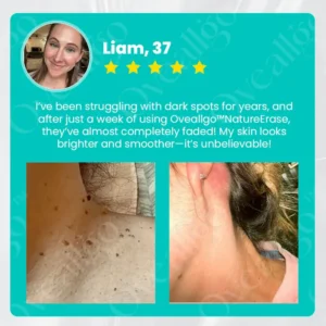 Oveallgo® NatureErase Plus Instant Mole & Spot Cream 19 Oveallgo® NatureErase Plus Instant Mole & Spot Cream