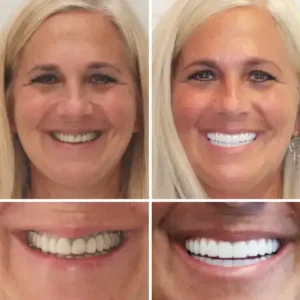 DentureGlow™ –Get a Perfect Smile Fast