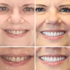 DentureGlow™ –Get a Perfect Smile Fast