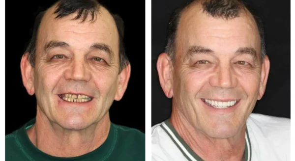 HZA™ Advanced Customized Full Denture Set - Image 11