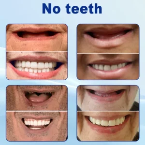 BQYOOM™-🦷Advanced Customized Full Denture Set