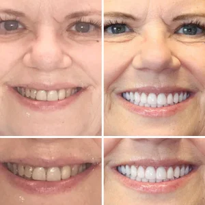 HZA™ --🦷Advanced Customized Full Denture Set